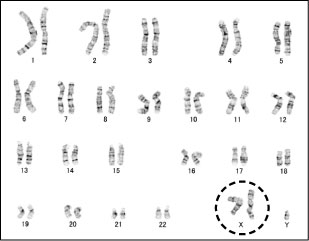 症候群 クライン フェルター